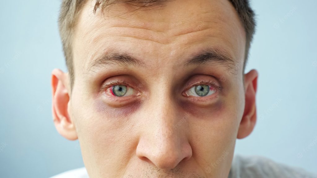 young-man-with-red-eyes-looking-camera_255755-3848-1024x576.jpg